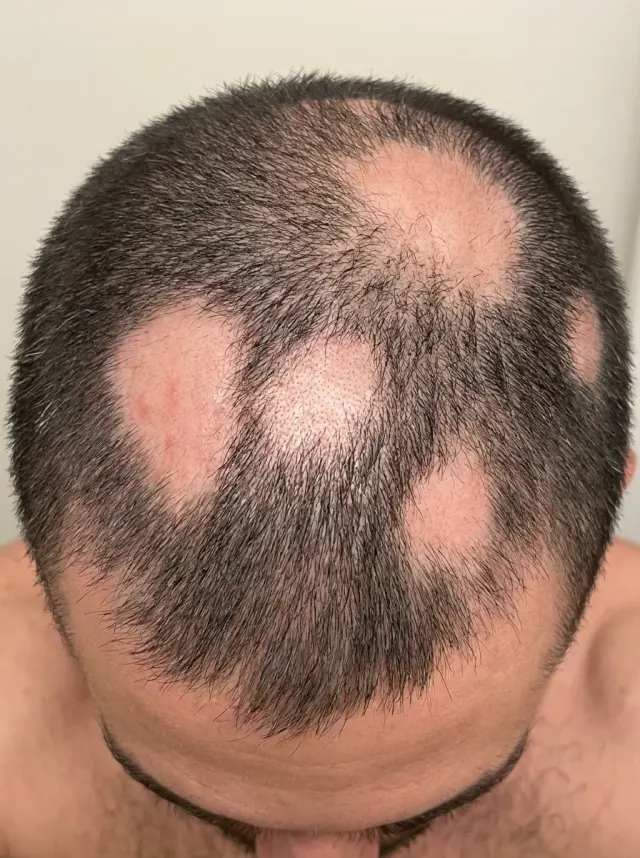Alopecia Androgenética — Antes