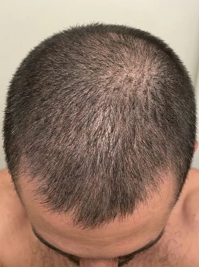 Alopecia Androgenética — Depois