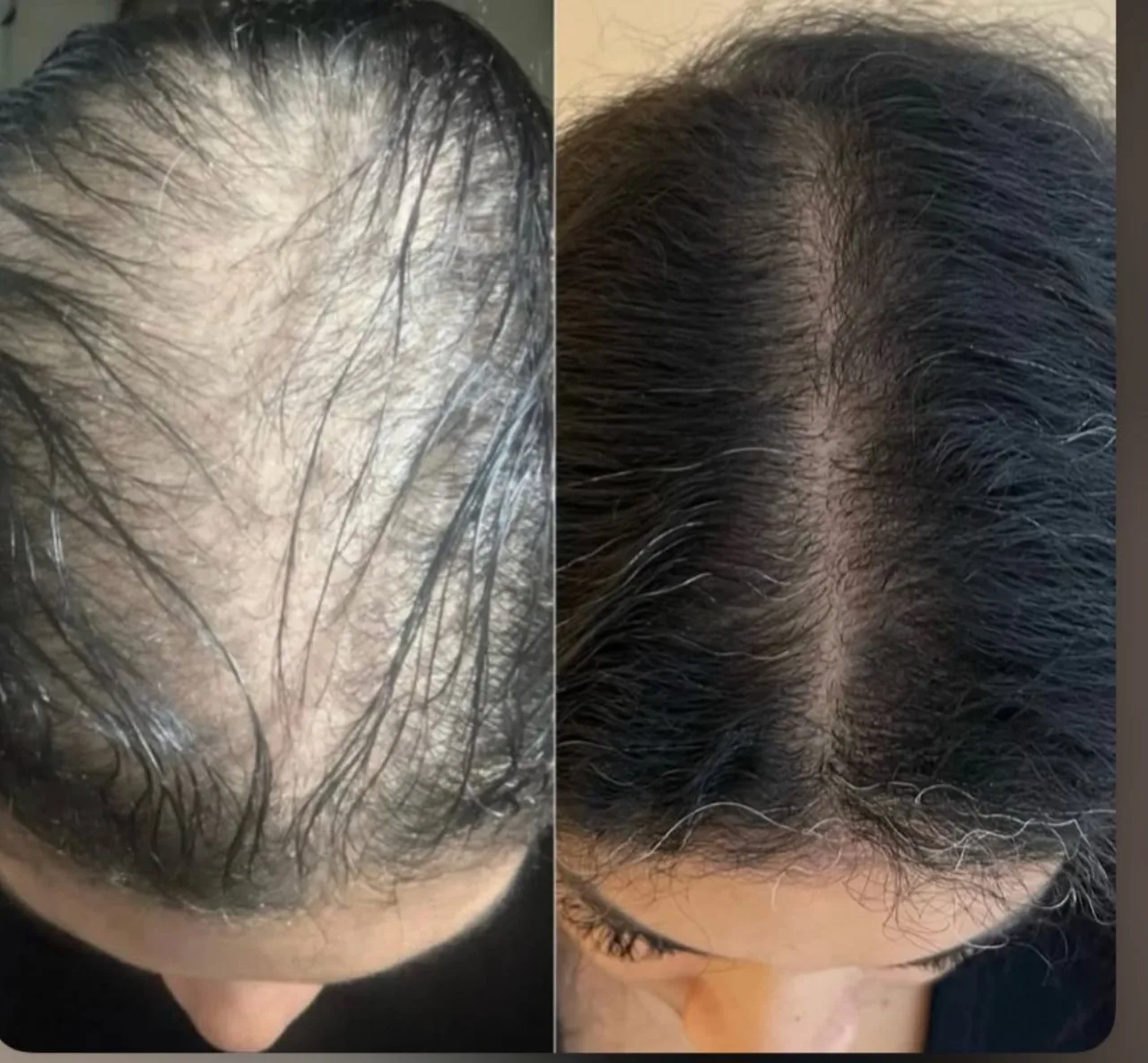 Queda Pós-Parto — Antes e Depois