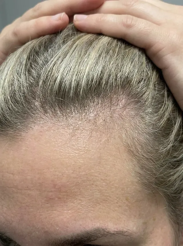 Dermatite Seborreica — Depois